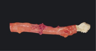 Smoking clogs your arteries