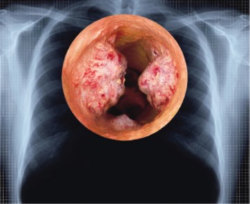 Smoking causes lung cancer