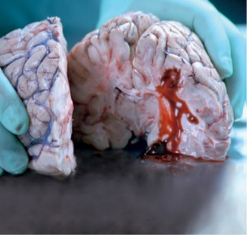 Smoking doubles your risk of stroke