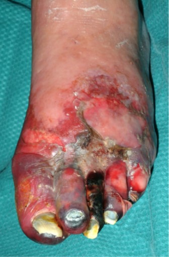 Smoking causes peripheral vascular disease
