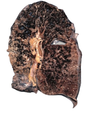 Smoking causes emphysema