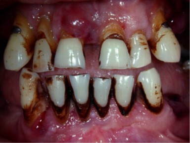 Smoking damages your gums and teeth
