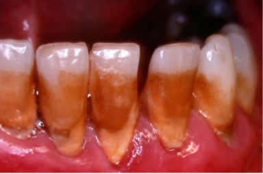 Smoking damages your gums and teeth